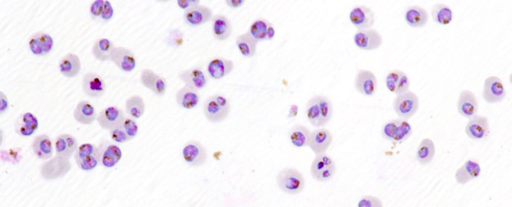 Paludisme - Découverte chez le parasite d'un marqueur moléculaire associé à la résistance au traitement à la piperaquine - Institut Pasteur Paludisme - Découverte chez le parasite d'un marqueur moléculaire associé à la résistance au traitement à la piperaquine - Institut Pasteur
