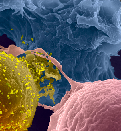 Lymphocyte infecté par le VIH-1 en contact avec des lymphocytes non infectés. 