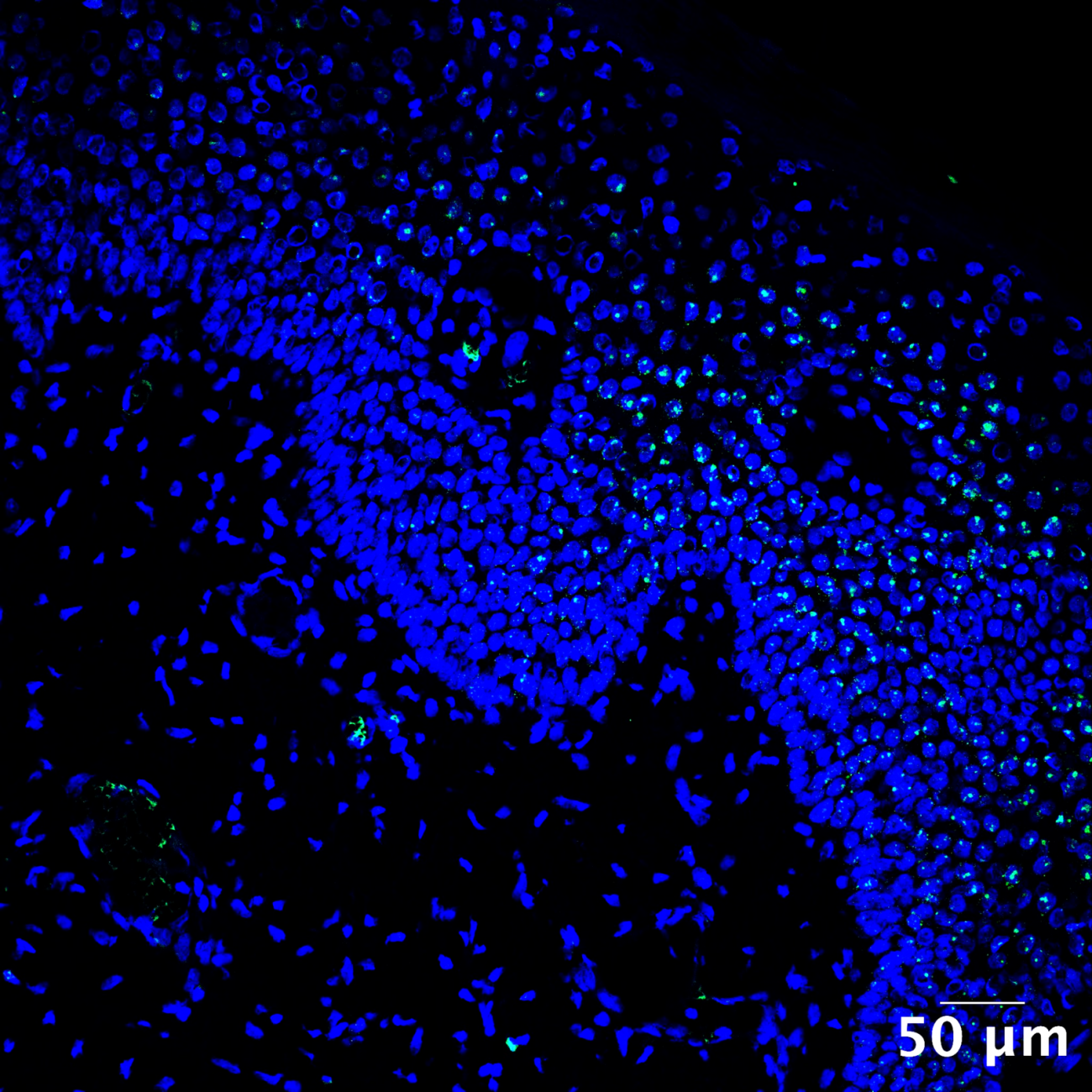 Porphyromonas asaccharolytica envahit la peau d’un malade Verneuil en stade sévère Porphyromonas asaccharolytica envahit la peau d’un malade Verneuil en stade sévère