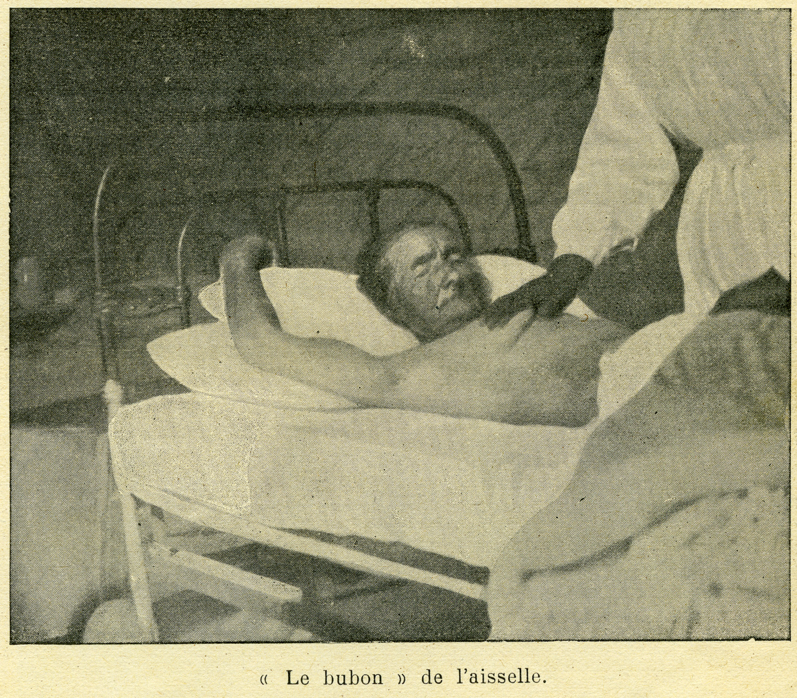 "Le bubon de l'aisselle", image tirée d'un article de Paul-Louis Simond : "La peste, ses causes et ses remèdes "in "Le Mouvement Thérapeutique et médical" N°6 juin 1901.