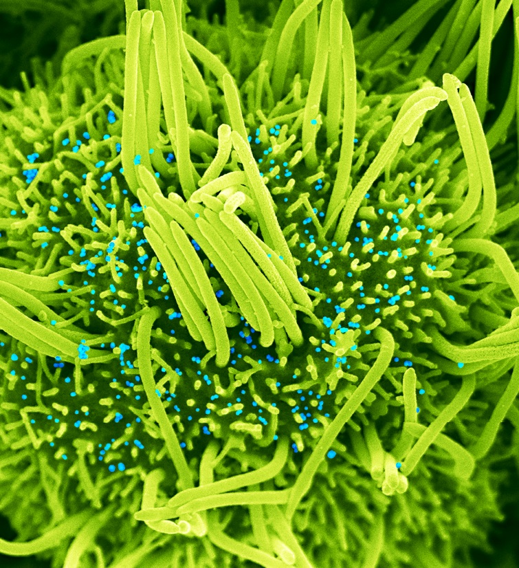 Human bronchial cells (green) infected with SARS-CoV-2 (blue) - Institut Pasteur Human bronchial cells (green) infected with SARS-CoV-2 (blue) - Institut Pasteur