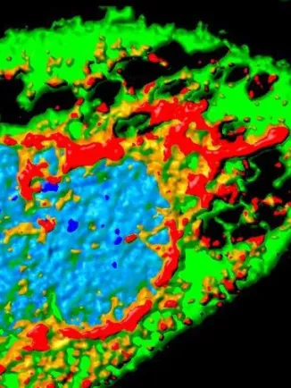 Cellule infectée par Zika (effet cytopathique), présentant de larges vacuoles (trous). En rouge : protéine virale. En vert : cellule. En bleu : noyau. Microscopie par immunofluorescence. 