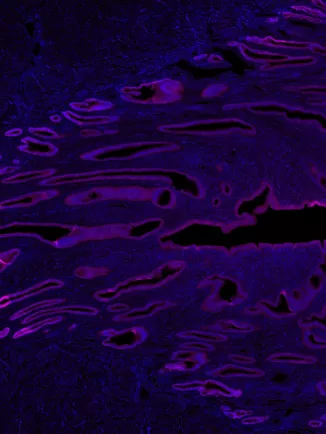 Image en immunofluorescence d'une coupe d'endomètre marquant les cellules épithéliales (magenta) et les noyaux des cellules (bleu).