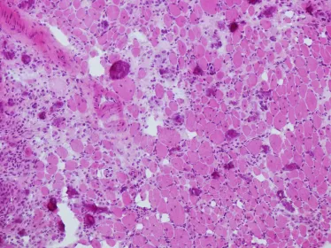 sepsis - Institut Pasteur