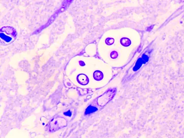Méningoencéphalite cryptococcique - Institut Pasteur
