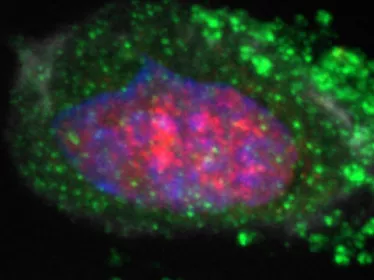 Découverte d’un marqueur de susceptibilité au cancer gastrique