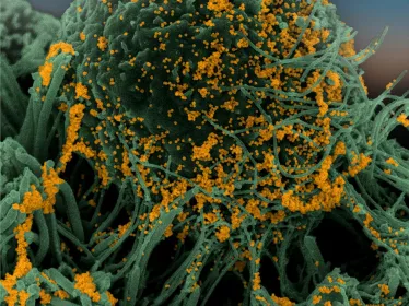 Cellules bronchiques humaines infectées par SARS-CoV-2