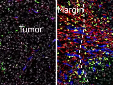 Les cellules stromales en marge de la tumeur © Institut Pasteur