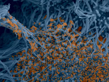 Cellules bronchiques humaines infectées par SARS-CoV-2 © Institut Pasteur