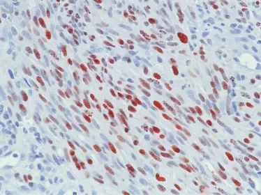 Sacrome Kaposi copyright Institut Pasteur