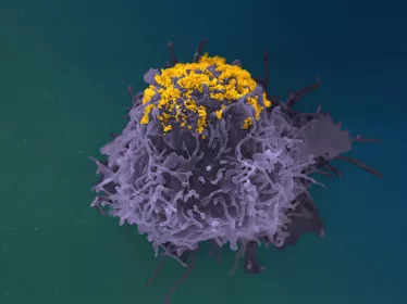 Accumulation de particules de VIH à la surface d’une cellule infectée