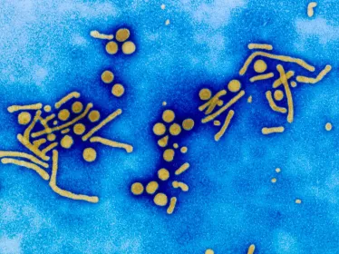 Virus de l'hépatite B (VHB) en microscopie électronique. L'hépatite B chronique peut être à l'origine de cancer du foie et de cirrhose. Virus enveloppé à ADN. Particules de Dane complètes, sphérules de 20 nanomètres de diamètre, et tubules ou filaments de