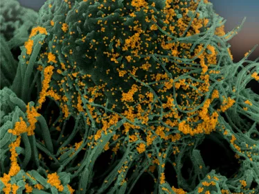 Cellules bronchiques humaines (en vert) infectées par SARS-CoV-2 (orange). Image obtenue par microscopie électronique à balayage puis colorisée.