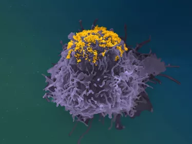 Accumulation de particules de VIH à la surface d’une cellule infectée