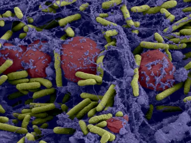Biofilm de bactéries Pseudomonas aeruginosa formé dans un catheter central.