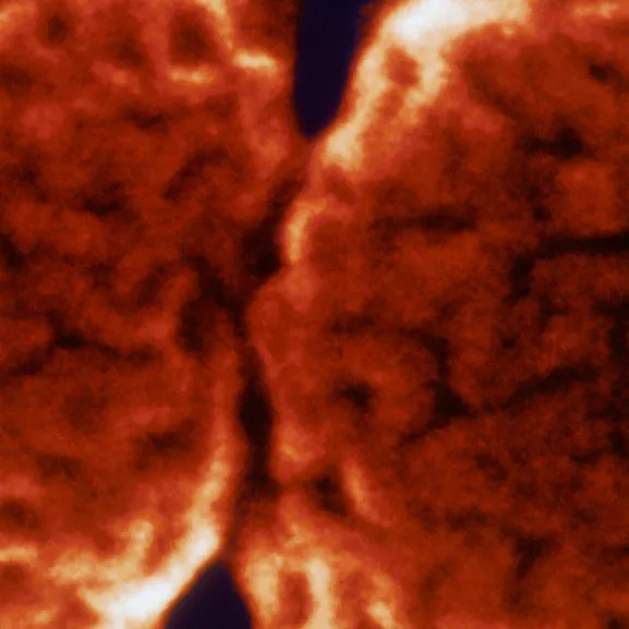 Santé Publique - CCOMS - Méningites bactériennes - Institut Pasteur