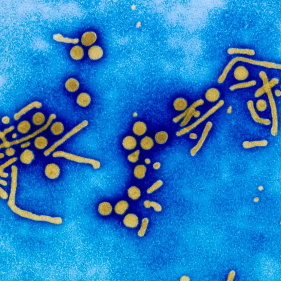 Virus de l'hépatite B (VHB) en microscopie électronique. L'hépatite B chronique peut être à l'origine de cancer du foie et de cirrhose. Virus enveloppé à ADN. Particules de Dane complètes, sphérules de 20 nanomètres de diamètre, et tubules ou filaments de