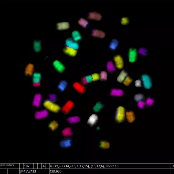 Chromosomes métaphasiques d’une cellule lymphoïde cancéreuse