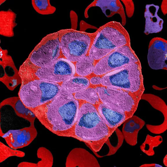 Globule rouge parasité par Plasmodium falciparum