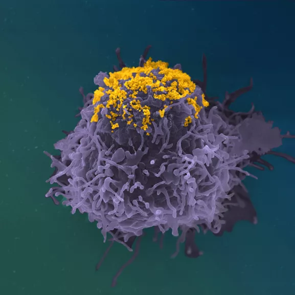 Accumulation de particules de VIH à la surface d’une cellule infectée