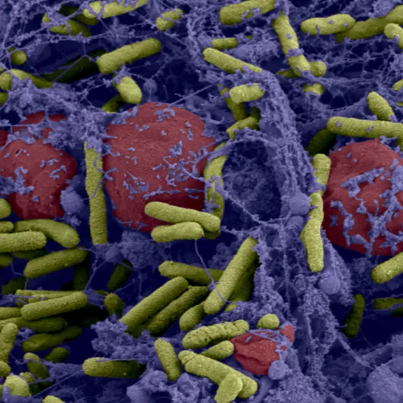 Biofilm de bactéries Pseudomonas aeruginosa formé dans un catheter central.