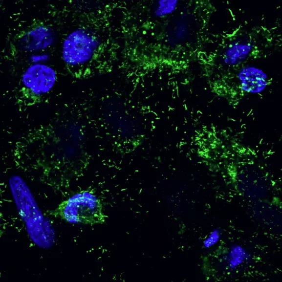 Infection par le virus respiratoire syncytial (VRS)