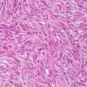 Fiches maladies - Sarcome de Kaposi - Institut Pasteur