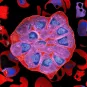 Globule rouge parasité par Plasmodium falciparum 