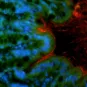 Un déséquilibre du microbiote intestinal favorise la survenue d’un cancer colorectal 