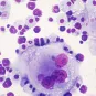 Allogreffe de cellules souches hématopoïétiques : des travaux mettent en évidence les modifications majeures du métabolome humain au cours de la réaction du greffon contre l’hôte 