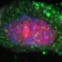 Découverte d’un marqueur de susceptibilité au cancer gastrique