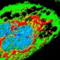 Cellule infectée par Zika (effet cytopathique), présentant de larges vacuoles (trous). En rouge : protéine virale. En vert : cellule. En bleu : noyau. Microscopie par immunofluorescence. 
