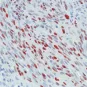 Sacrome Kaposi copyright Institut Pasteur