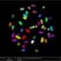 Chromosomes métaphasiques d’une cellule lymphoïde cancéreuse 