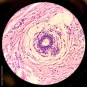 hidradenitis suppurativa © AdobeStock
