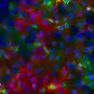 Infection de cellules humaines par un virus Chikungunya fluorescent (rouge et vert).