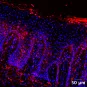 Immunoglobluline A (IgA) dans une peau d’un malade Verneuil en stade sévère