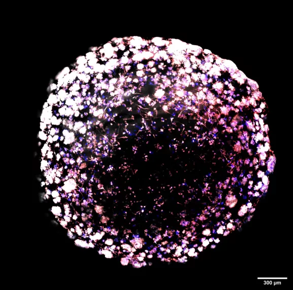 Structures de type TNT (Tunneling nanotubes) et extensions de type TM « tumor microtubes » dans un organoïde tumoral de cellules souches de glioblastome (CSG). Image à fluorescence représentative d’un organoïde tumoral de CSG après 23 jours de culture, coloré pour l’anti-tubuline alpha (microtubules, blanc) et la phalloïdine (actine, rouge). Différents types de connexions sont présents et coexistent à l’intérieur de l’organoïde. Les organoïdes tumoraux constituent une méthode de culture tridimensionnelle ad