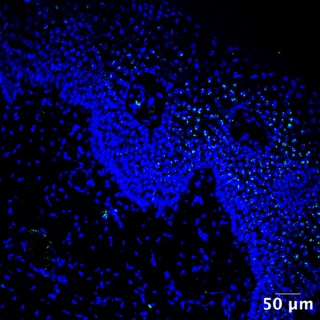 Porphyromonas asaccharolytica envahit la peau d’un malade Verneuil en stade sévère