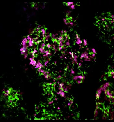 Cellules cancéreuses et macrophages s’attaquant aux cellules tumorales