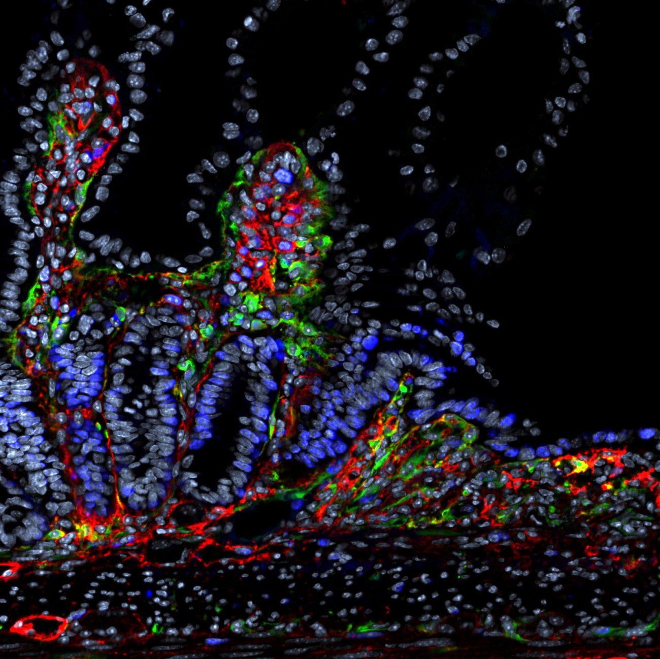Ulcère inflammatoire de l'intestin