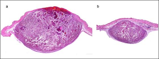 Coupe histologique de deux mélanomes murins (a) non traité et (b) traité avec sitagliptine. © Institut Pasteur
