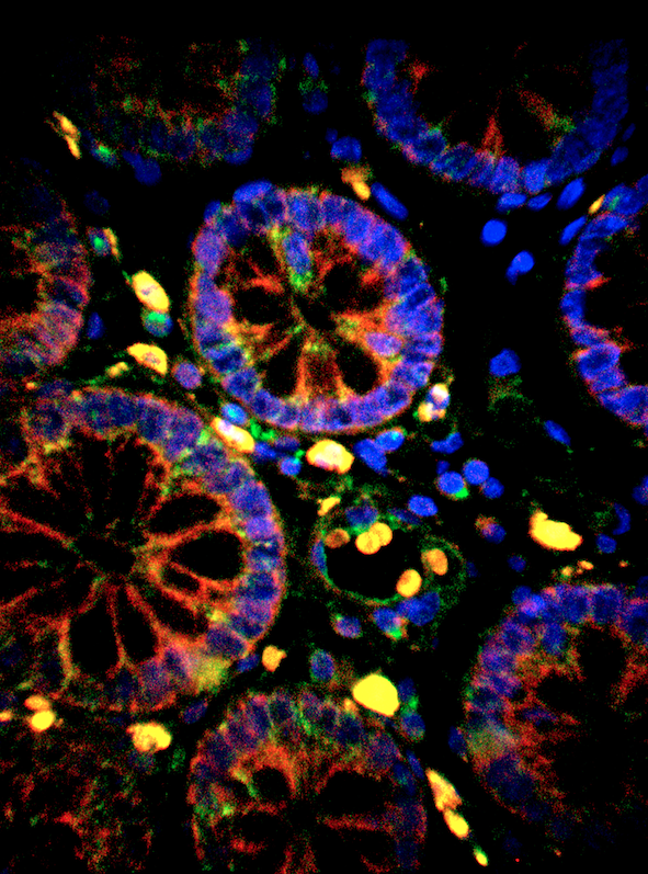 Les mitochondries dans le cancer du colon humain