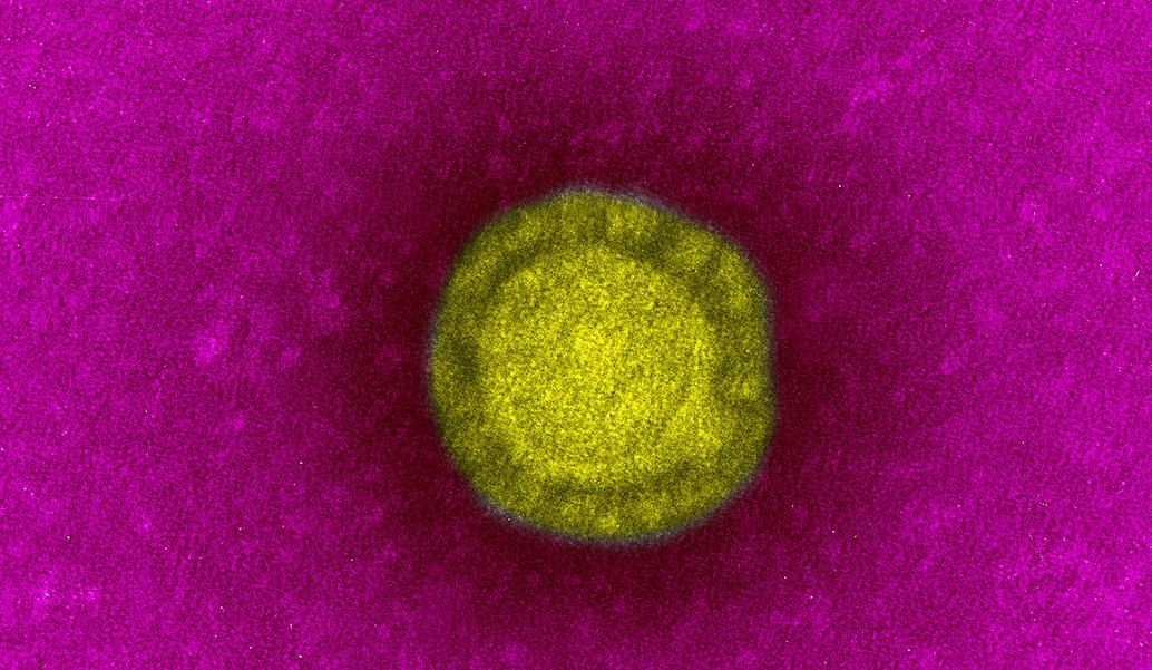 Légende: Coronavirus SARS-CoV responsable de l'épidémie de SRAS (Syndrome Respiratoire Aigu Sévère) en 2003. Microscopie électronique colorisée.