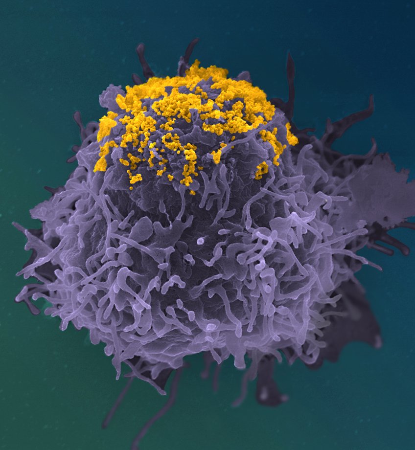 Accumulation de particules de VIH (en jaune) à la surface d’une cellule infectée (en violet) entrainée par l’action d’anticorps à large spectre (bNAbs).