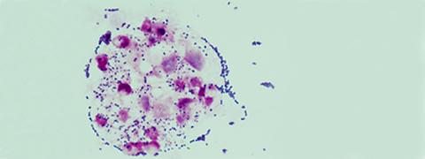 Streptococcus agalactiae dans des globules blancs. © Claire Poyart, CNR-Strep (AP-HP, Inserm)