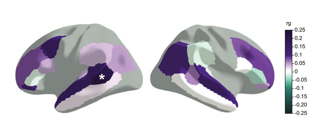 Régions cérébrales dont la surface est associée à certaines des variations génétiques associées à la performance en langage oral et écrit. Le code couleur indique la corrélation génétique (rg).