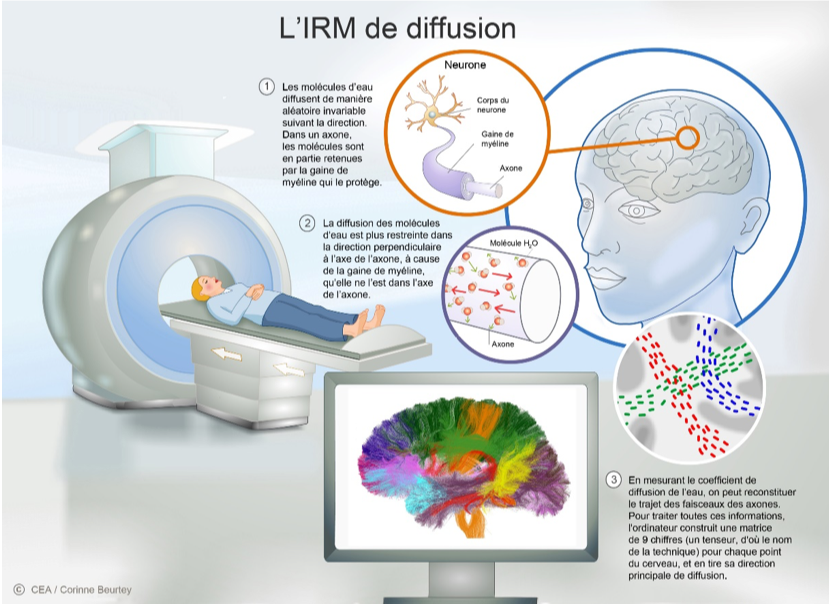 Effets du lithium sur le cerveau dans le trouble bipolaire Effets du lithium sur le cerveau dans le trouble bipolaire
