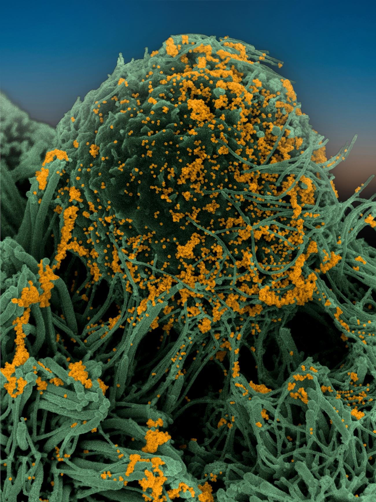 Cellules bronchiques humaines infectées par SARS-CoV-2