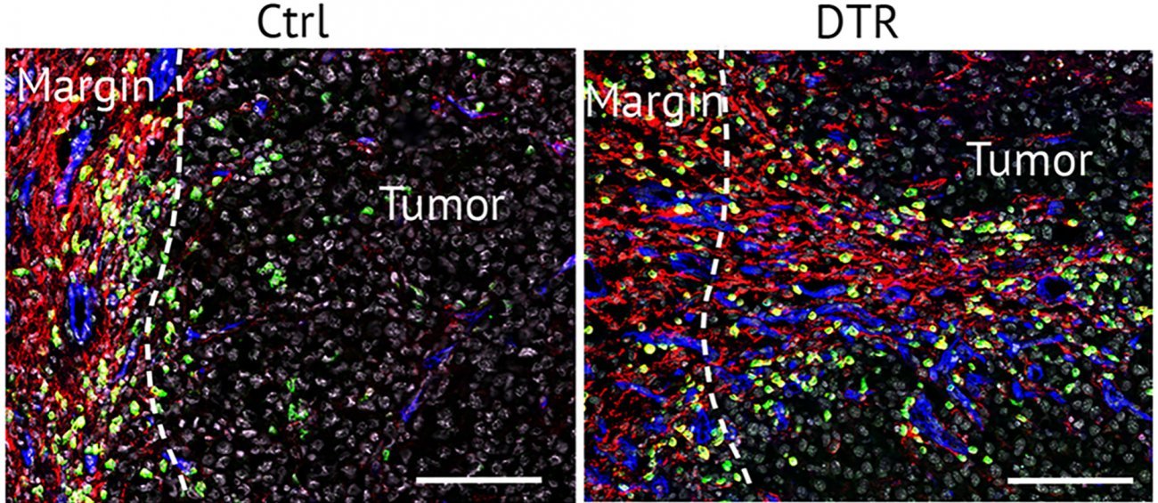 Les cellules stromales en marge d'une tumeur © Institut pasteur